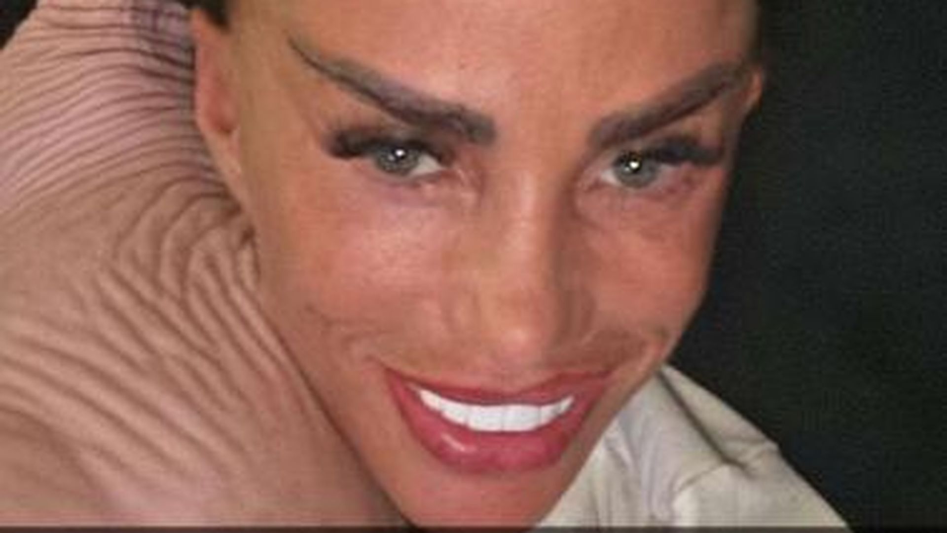 Katie Price zieht nach Facelift-OP selbst Fäden heraus