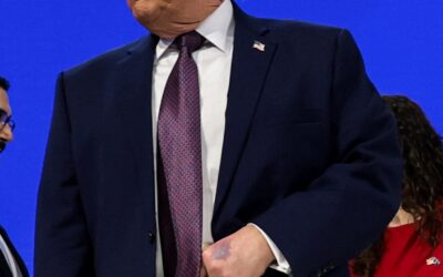 Dicker Fleck in Davos: Was ist da los mit Donald Trumps Hand?