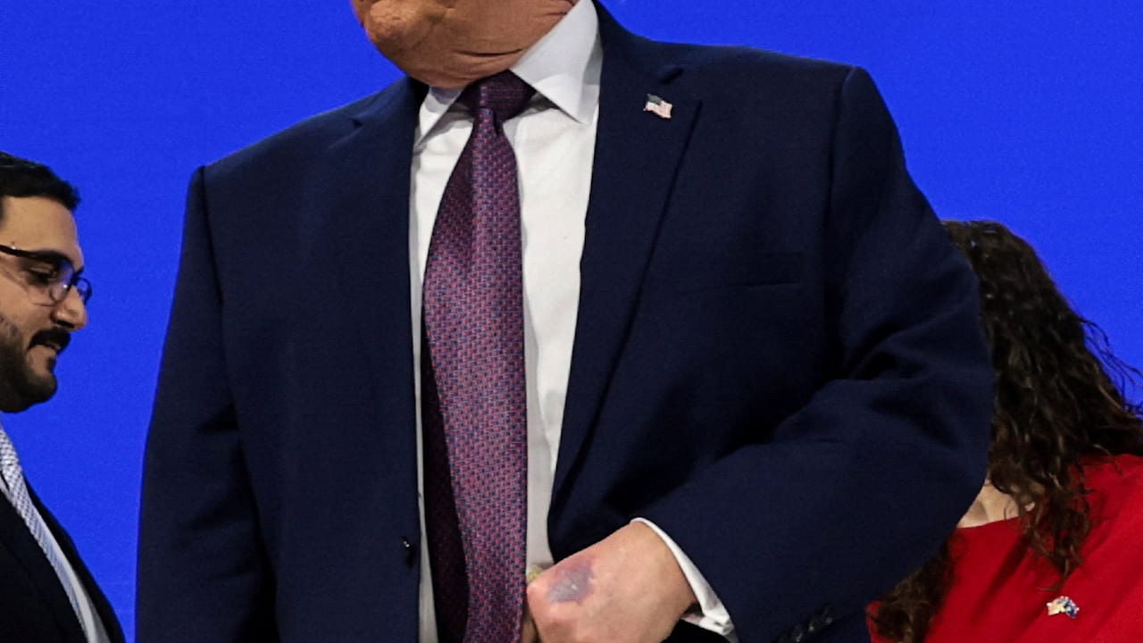 dicker-fleck-in-davos-was-ist-da-los-mit-donald-trumps-hand.jpg Dicker Fleck in Davos: Was ist da los mit Donald Trumps Hand?