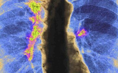 Krebs: Was neue Zahlen über die Krankheit verraten