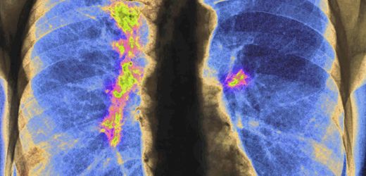 krebs-was-neue-zahlen-ueber-die-krankheit-verraten.jpg Krebs: Was neue Zahlen über die Krankheit verraten