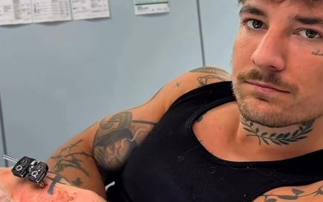 Gendefekt: Willi Whey ließ sich kleinen Finger verlängern