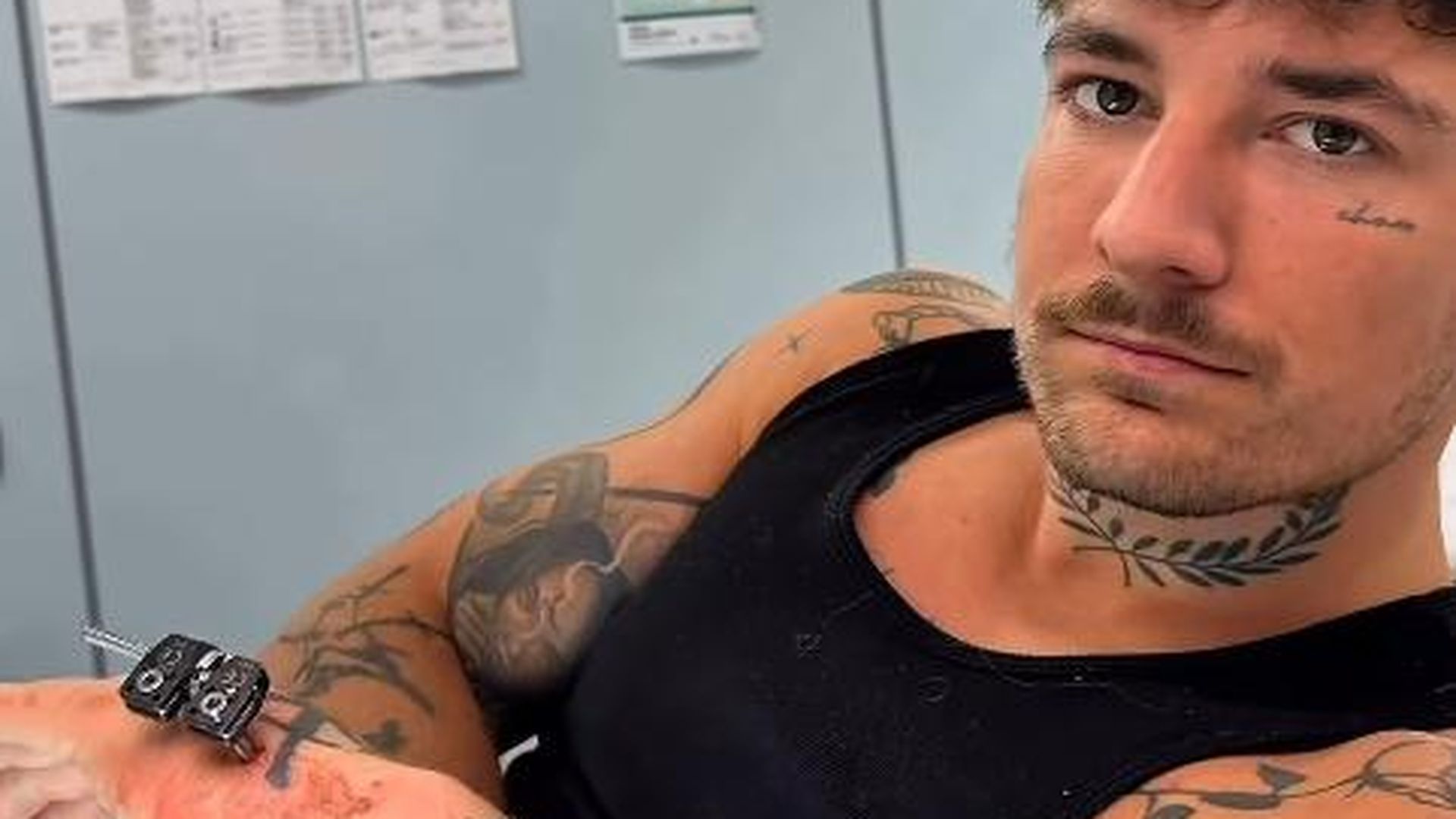 Gendefekt: Willi Whey ließ sich kleinen Finger verlängern